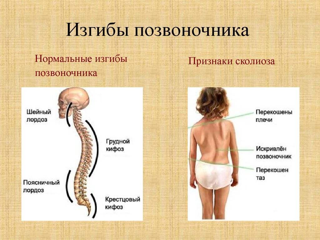 Сколиоз картинки для презентации